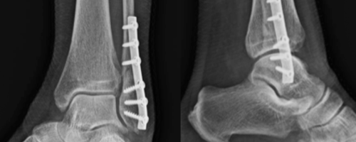 enkel operatie herstel